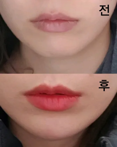 [Tiểu phẫu] Tuyệt vời - Filler cằm, Botox