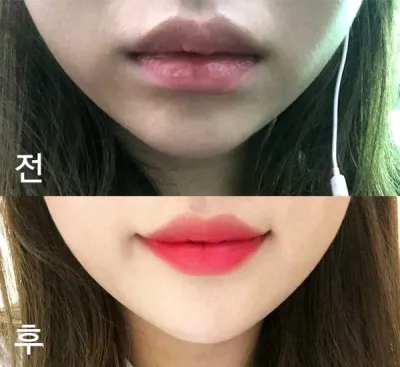 [Tiêm filler] Conkrongyi - Tiêm filler môi