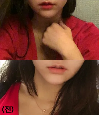 [Tiêm filler] ghyghy - Tiêm filler môi