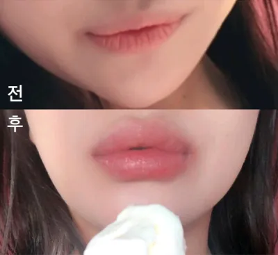 [Tiêm filler] bkbkbk - Tiêm filler môi