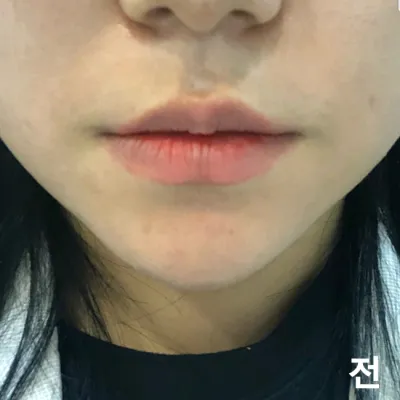 [Tiểu phẫu] Ttottoruya - Tiêm filler môi, Botox