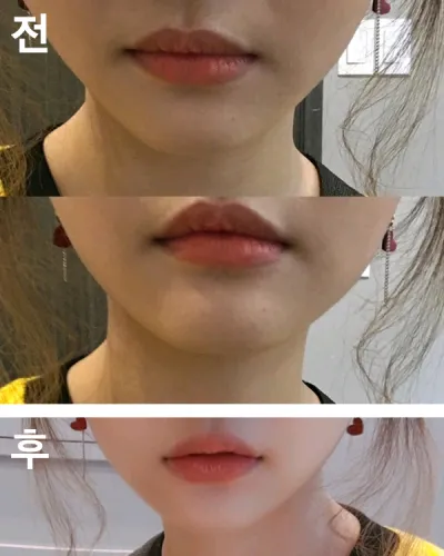 [Tiểu phẫu] Degulss - Tiêm filler môi