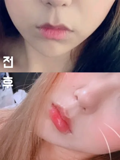 [Tiêm filler thẩm mỹ] Chichi Ke - Tiêm filler môi