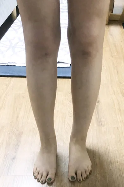 [Hút mỡ] Kkultabin - Hút mỡ bắp chân, bụng