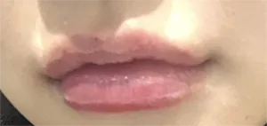 [Tiêm filler] MooHani - Môi