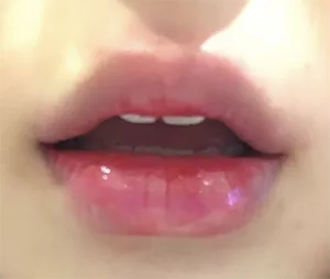 [Tiêm filler] titi - Môi