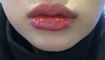 [Tiểu phẫu] Angko - Môi