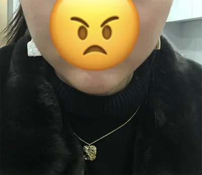 [Tiểu phẫu] Minjani - Botox, Filler cằm