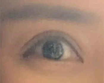 [Tiêm filler thẩm mỹ] Bay cao như những vì sao - Filler