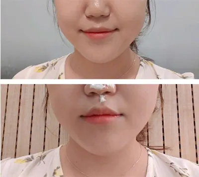 [Da] Dotte Nuri - Chỉ nâng cơ, Shurink