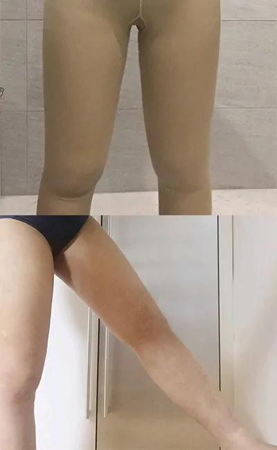 [Hút mỡ] Kyak Gik Kyak - Hút mỡ