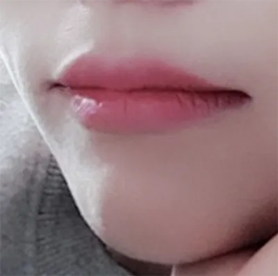 [Tiêm filler] Xứ sở thần tiên - Môi