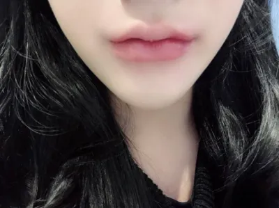 [Tiêm filler] Tzzgy - Môi