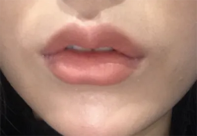 [Tiêm filler] lil887 - Môi
