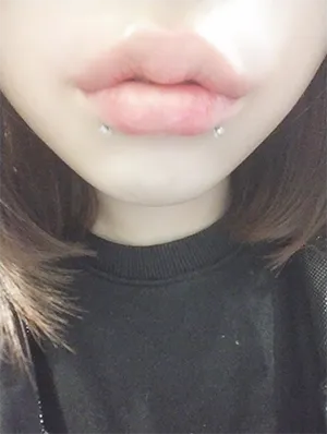 [Tiểu phẫu] 125688 - Môi