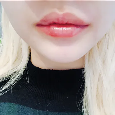 [Tiêm filler] Gomi00 - Môi