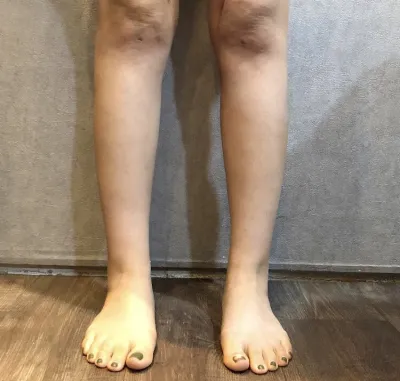 [Hút mỡ] Bay cao như ngôi sao - Hút mỡ bắp chân, bụng