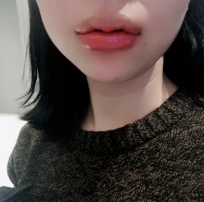 [Tiêm filler] Tôn Tôn - Môi