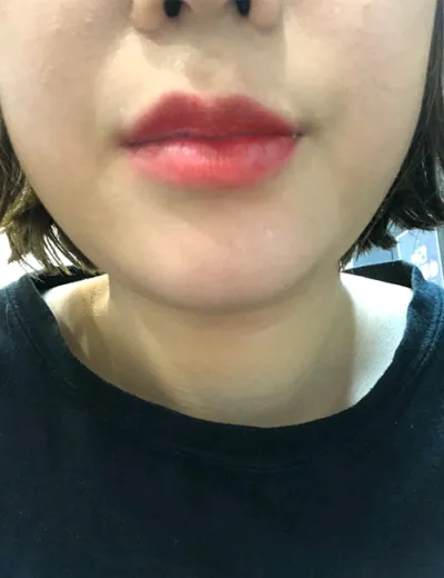 [Tiêm filler] Yo Sul Gon Ju - Tiêm filler môi