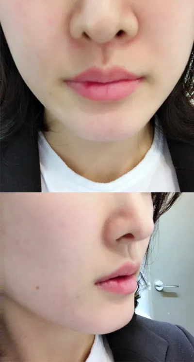 [Tiêm filler thẩm mỹ] Honghongdodo - Tiêm filler môi