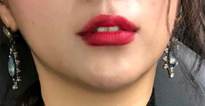 [Tiêm filler thẩm mỹ] Yeoguna - Tiêm filler môi