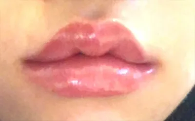 [Tiểu phẫu] Môi 1910 - Môi