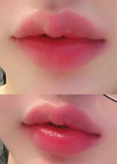 [Tiêm filler] 윤윤윤윤윤윤2 - Tiêm filler môi