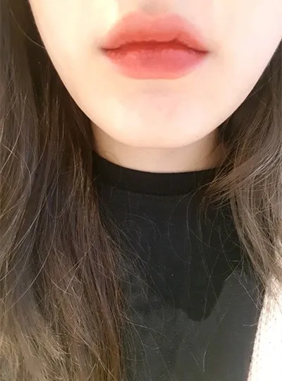 [Tiêm thẩm mỹ] Ji Ddol-i - Filler môi, Botox