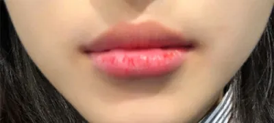 [Tiêm filler] Lee eee ddd - Tiêm filler môi