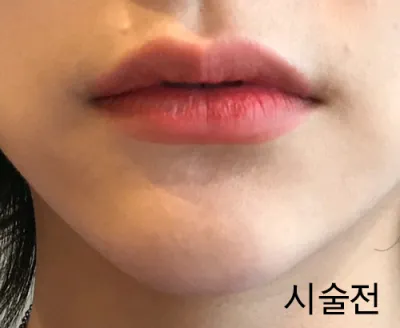 [Tiểu phẫu] Lallalingdong - Tiêm filler môi