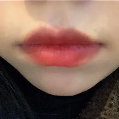 [Tiểu phẫu] Sưng tấy - Môi