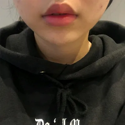 [Tiểu phẫu] Aigwichankeu - Tiêm filler môi