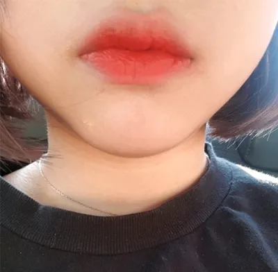 [Tiêm filler] awdrgyj - Filler môi, Botox