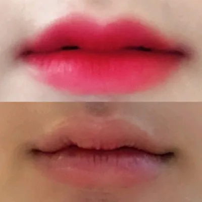 [Tiêm filler] sodh - Tiêm filler môi