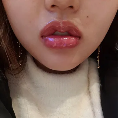 [Tiêm filler] ss5773 - Môi