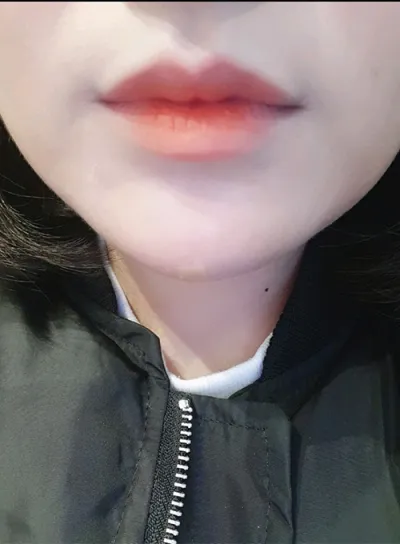 [Tiêm filler] kkd0229 - Tiêm filler môi