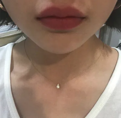 [Tiểu phẫu] yung148 - Tiêm filler môi, Botox