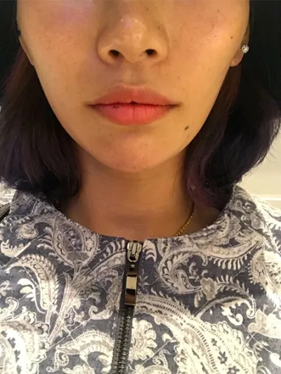 [Tiêm thẩm mỹ] 화장하는고양이 - Tiêm filler môi, Botox