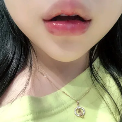 [Tiêm filler] Bean 1234 - Filler môi