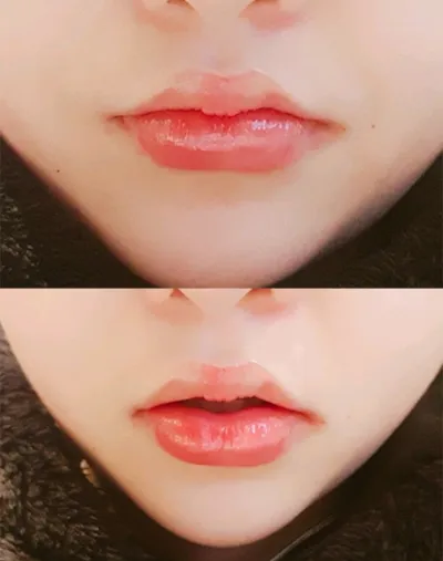 [Tiểu phẫu] Kim Công Chúa, - Tiêm filler môi, Botox