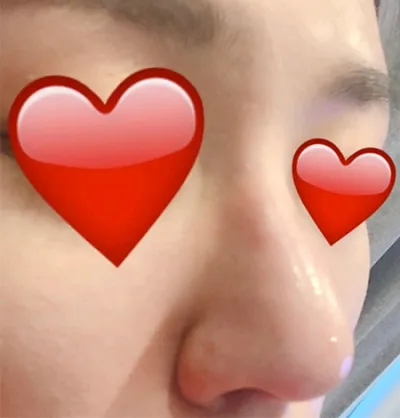 [Tiểu phẫu] 2080 Chiyaaku - Tiêm tạo hình mũi, Botox