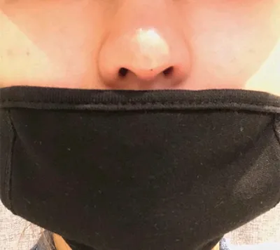 [Tiêm thẩm mỹ] Momo99 - Tiêm tan mỡ mũi