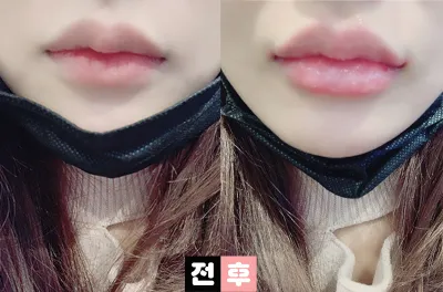 [Tiểu phẫu] Yeo-eo-eo-eong - Tiêm filler môi