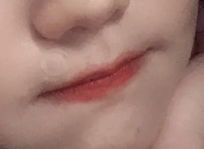 [Tiêm filler] vvrimb27 - Tiêm filler môi