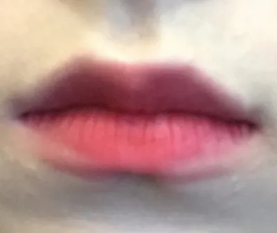 [Tiểu phẫu] Cắt mí thành công - Tiêm filler môi