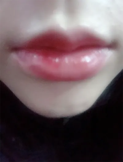 [Tiểu phẫu] 330330 - Môi