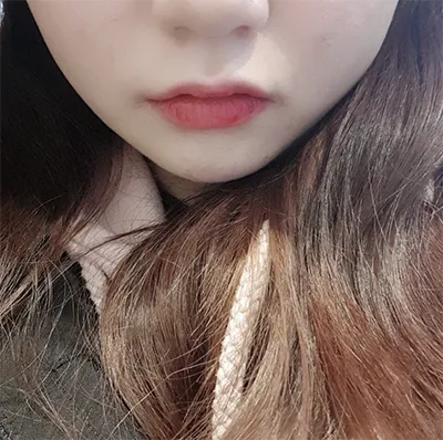 [Tiêm thẩm mỹ] Jangiyaa - Ultherapy, Botox