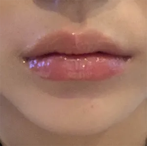 [Tiêm filler thẩm mỹ] Seoroin - Môi