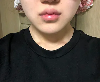 [Da] Bắn máy - Ultherapy