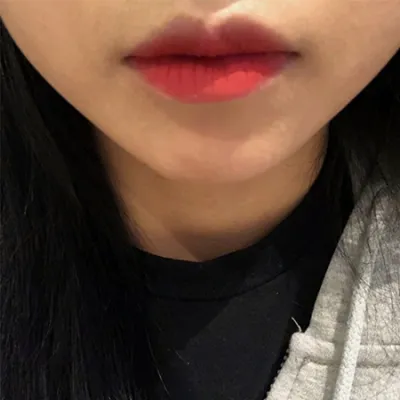 [Tiểu phẫu] I1 Pretty Dew - Tiêm filler khóe miệng, Botox